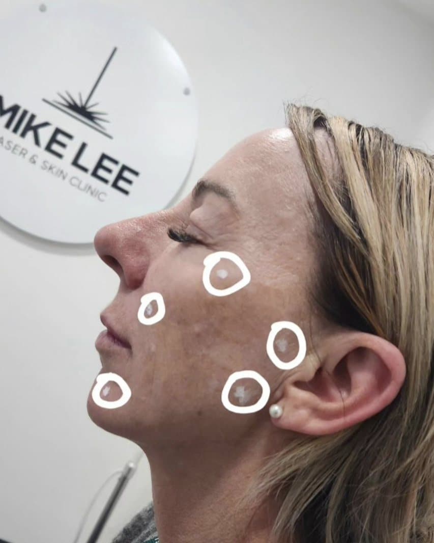 A client's face marked for Profhilo injection points at Mike Lee Laser & Skin Clinic