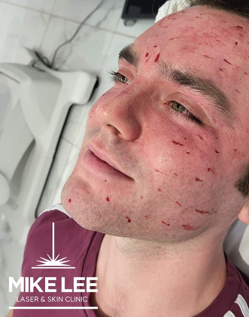PRP (Vampire) Facial at Mike Lee Laser & Skin Clinic
