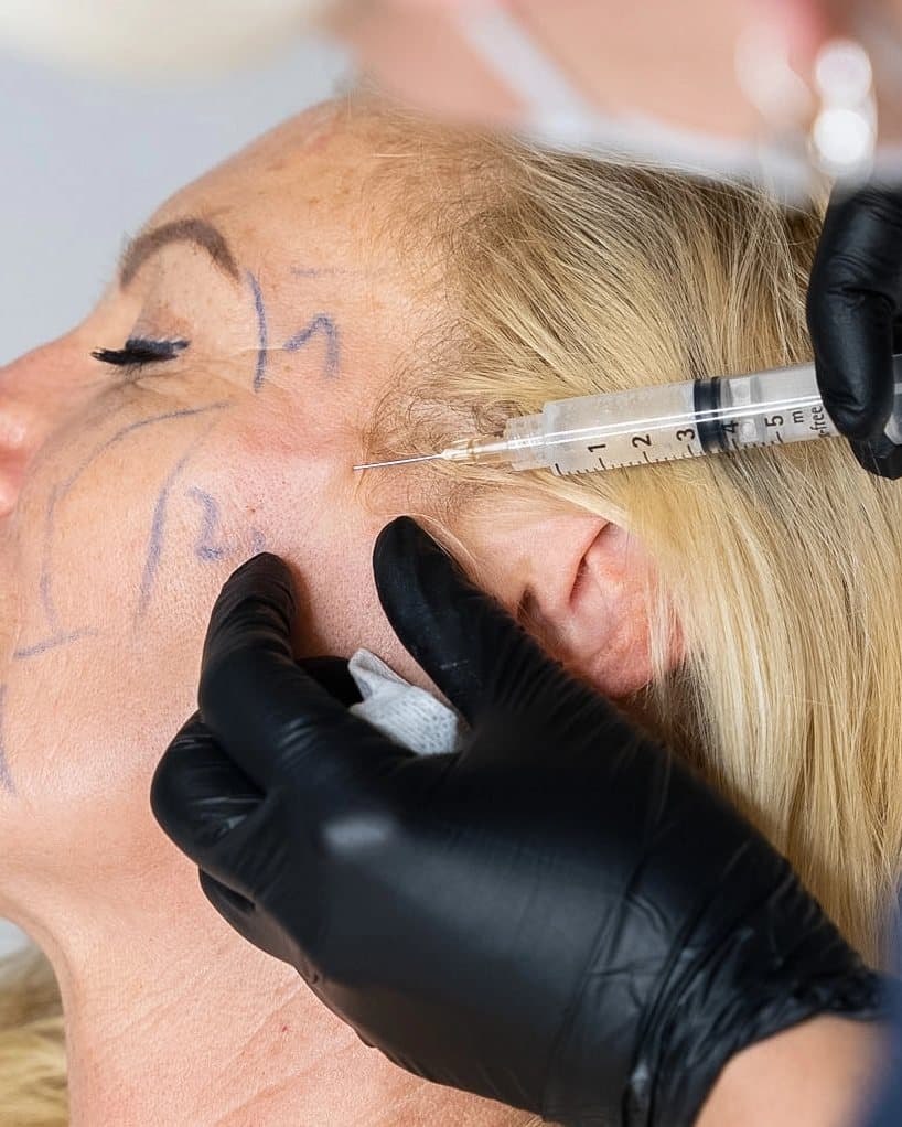 A Sculptra injection along the jawline at Mike Lee Laser & Skin Clinic