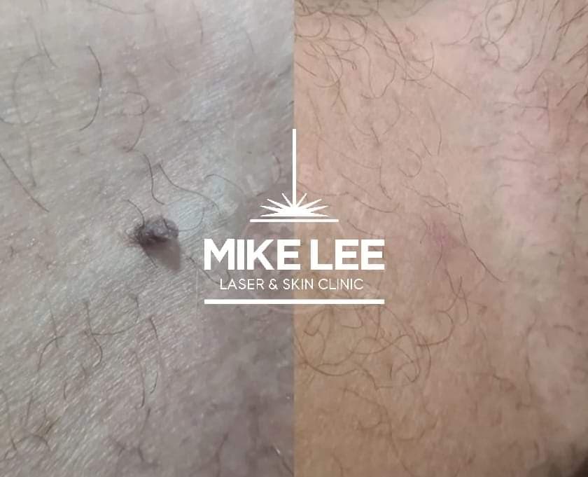 Skin Tag Removal at Mike Lee Laser & Skin Clinic