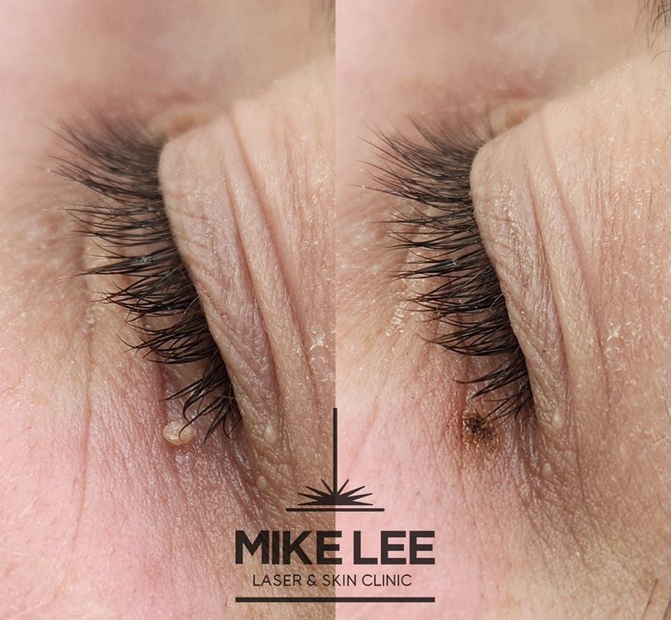 Skin lesion removal at Mike Lee Laser & Skin Clinic