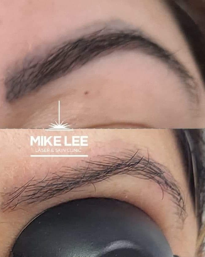 A tattooed eyebrow before and after removal at Mike Lee Laser & Skin Clinic