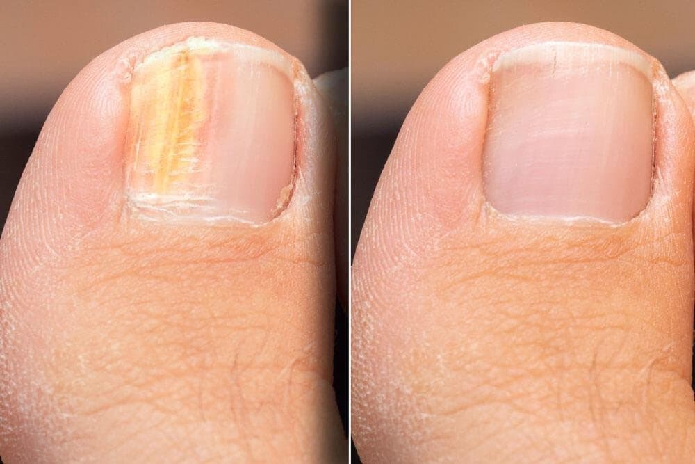A toenail before and after laser fungal nail treatment at Mike Lee Laser & Skin Clinic