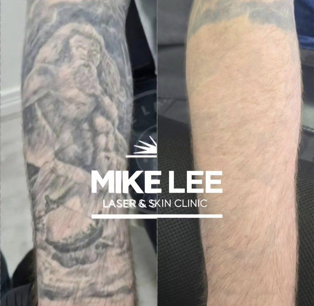 A tattooed arm before and after laser tattoo removal at Mike Lee Laser & Skin Clinic
