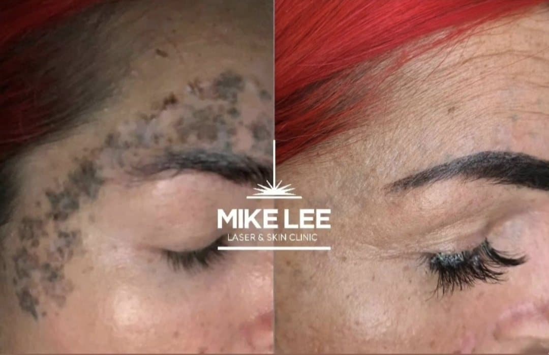 Tattoo pigment above an eyebrow before and after laser removal at Mike Lee Laser & Skin Clinic