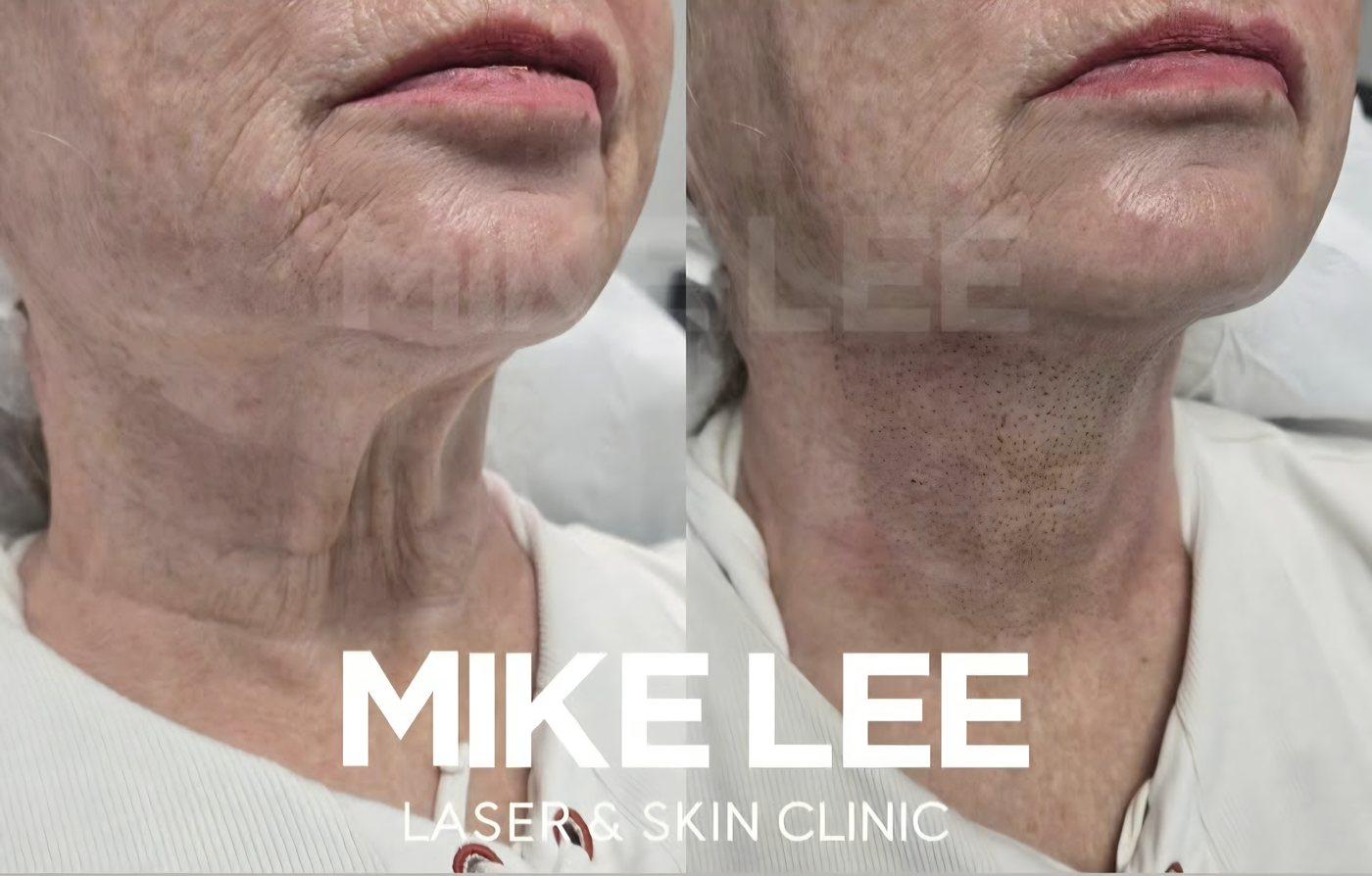 A client's neck before and after plasma skin tightening at Mike Lee Laser & Skin Clinic