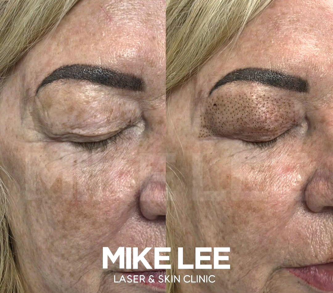 An eyelid before and after plasma skin tightening at Mike Lee Laser & Skin Clinic