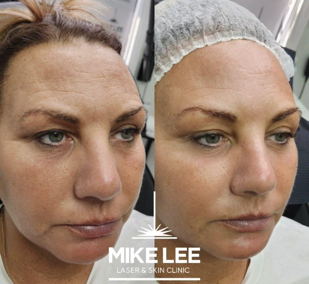 A client's face before and after Profhilo at Mike Lee Laser & Skin Clinic