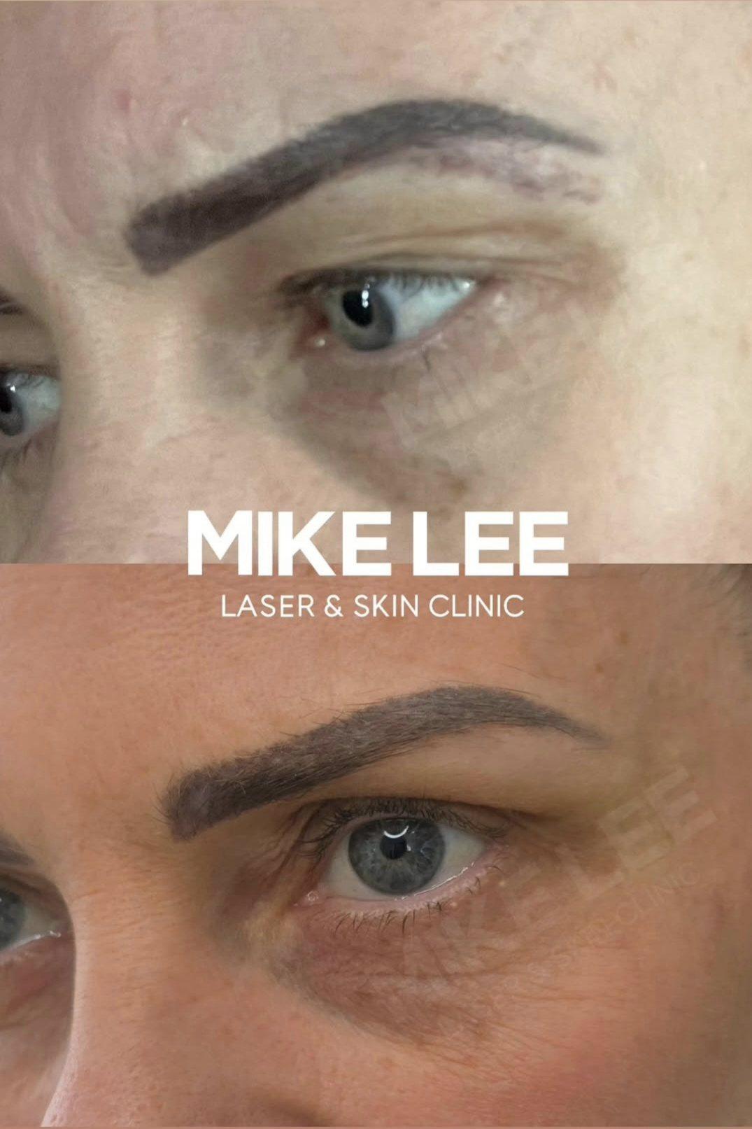 Eyebrows before and after tattoo brow removal at Mike Lee Laser & Skin Clinic