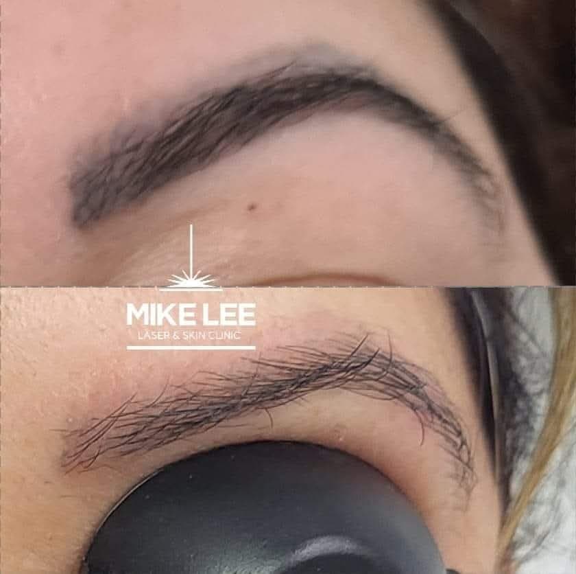 A tattooed eyebrow before and after removal at Mike Lee Laser & Skin Clinic