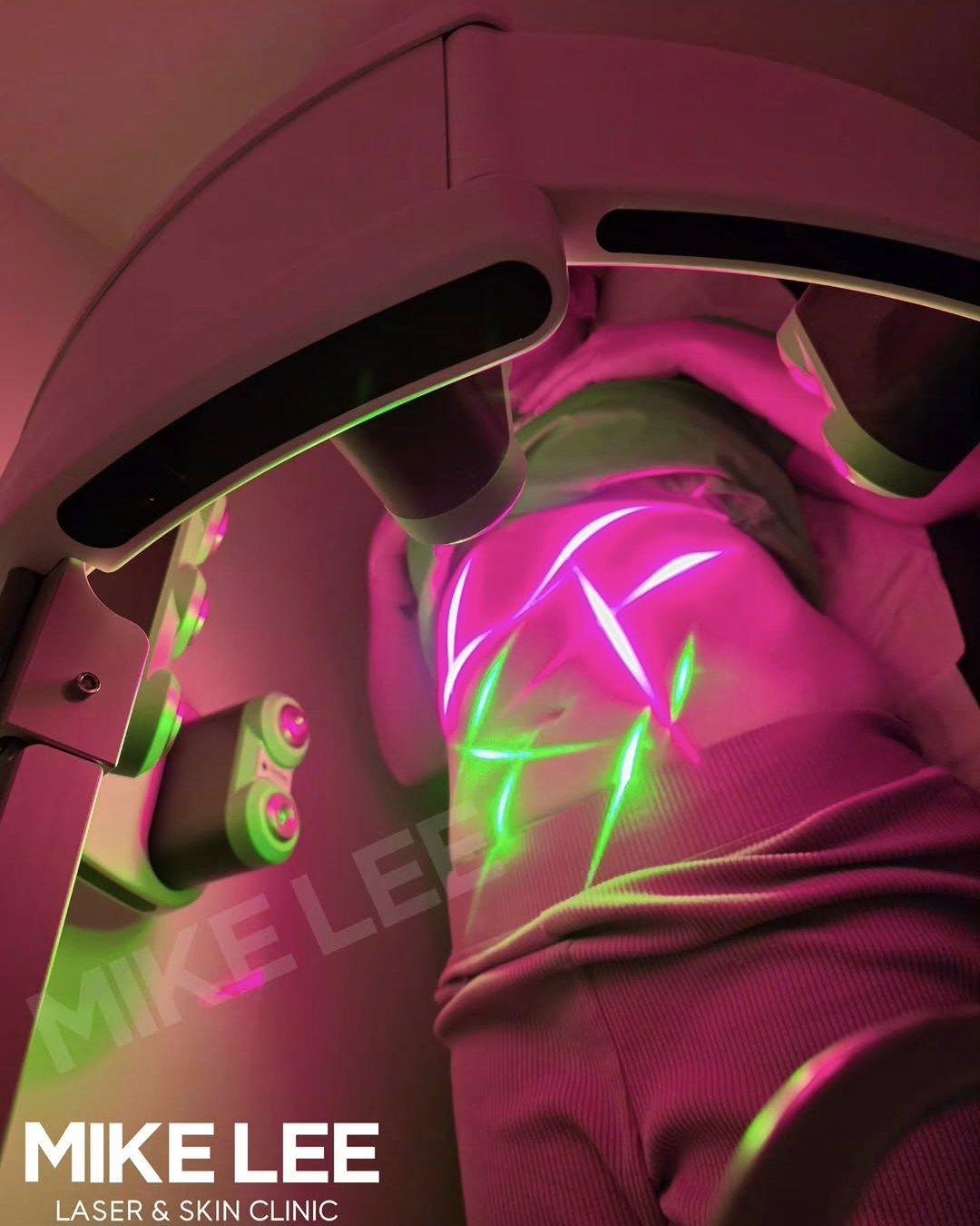 10D laser lipolysis machine over a client's abdomen at Mike Lee Laser & Skin Clinic