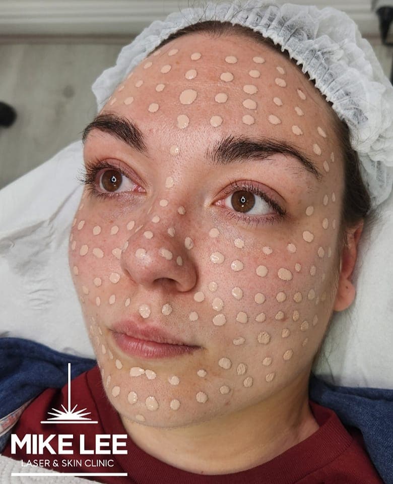 BB Fresh Facial at Mike Lee Laser & Skin Clinic