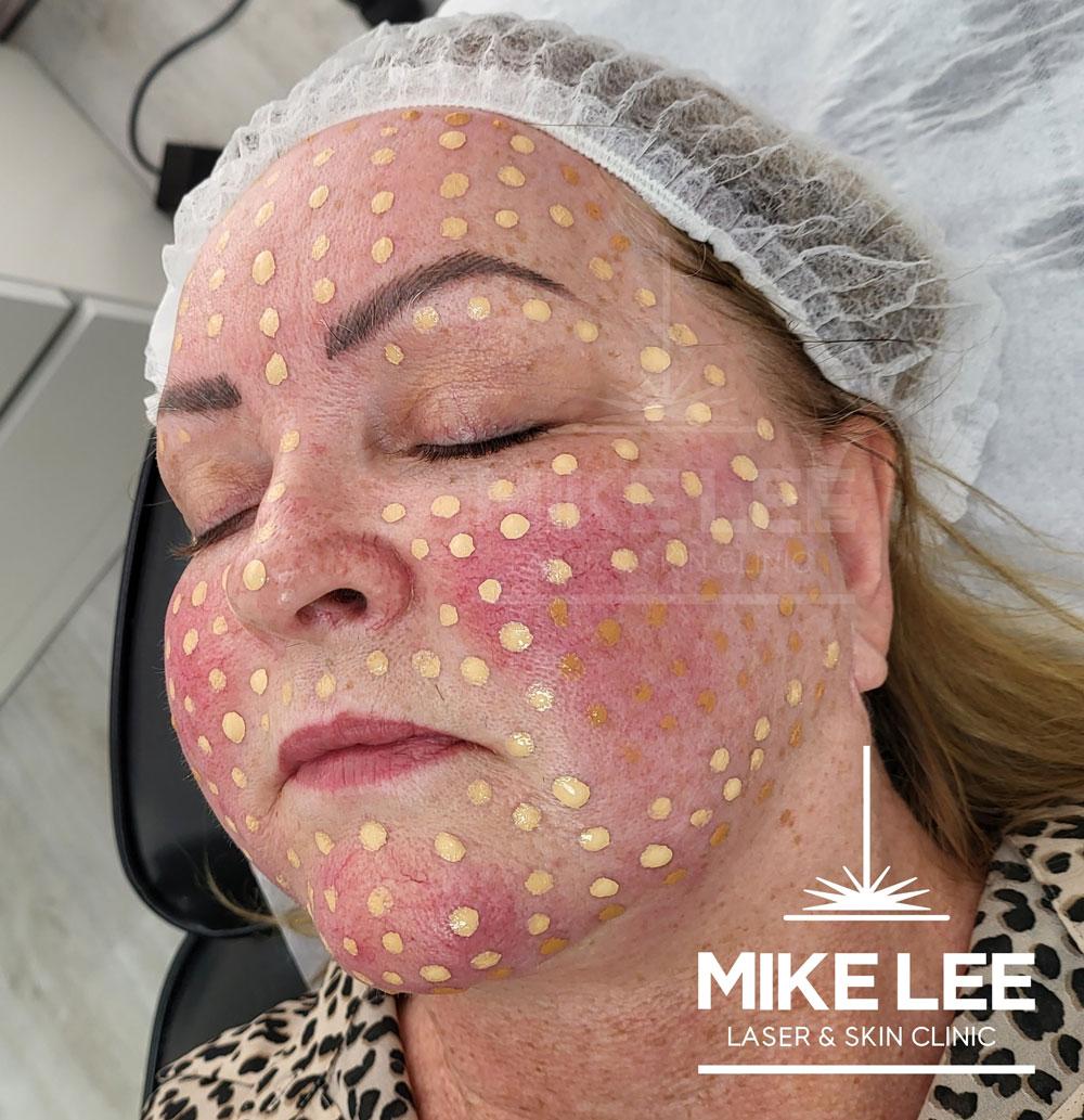 BB Fresh Facial at Mike Lee Laser & Skin Clinic