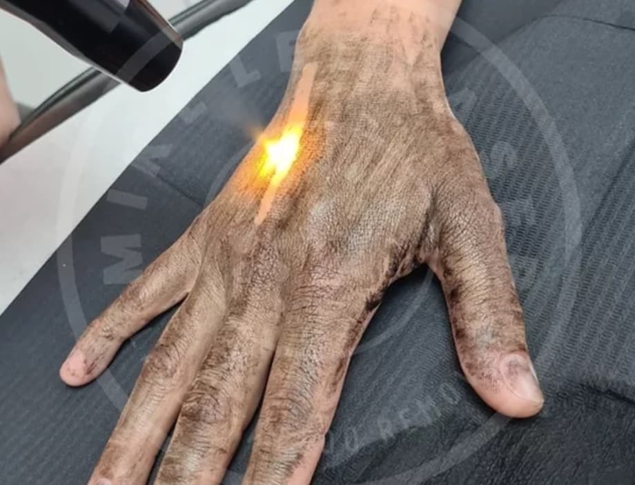 Carbon Skin Rejuvenation at Mike Lee Laser & Skin Clinic