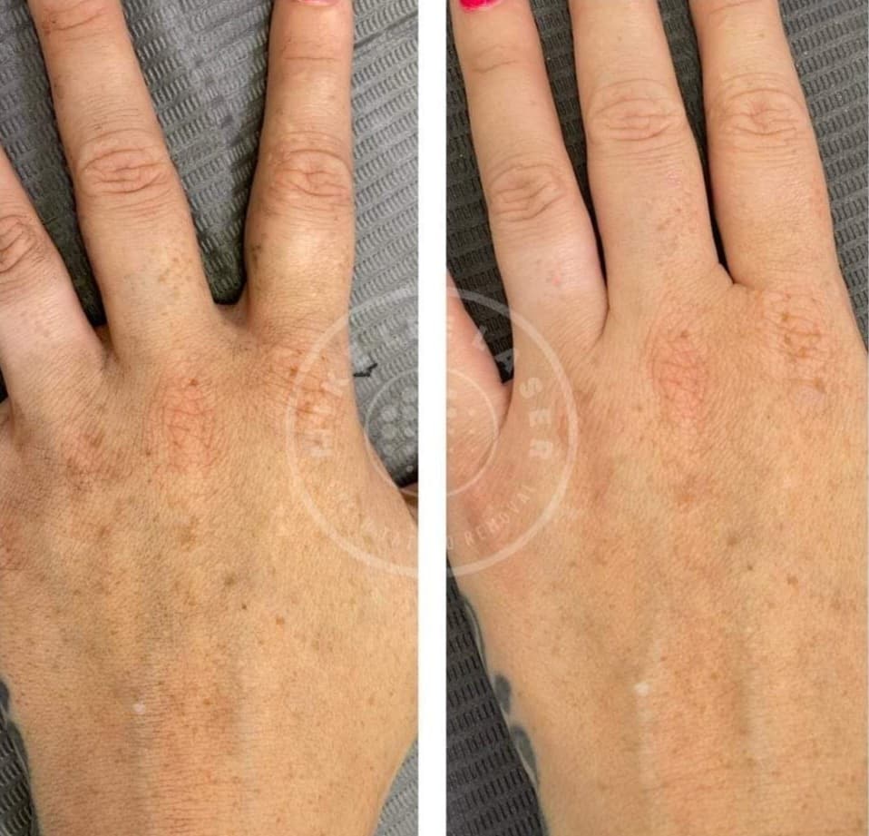 Carbon Skin Rejuvenation at Mike Lee Laser & Skin Clinic