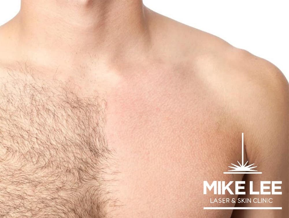 Laser Hair Removal at Mike Lee Laser & Skin Clinic