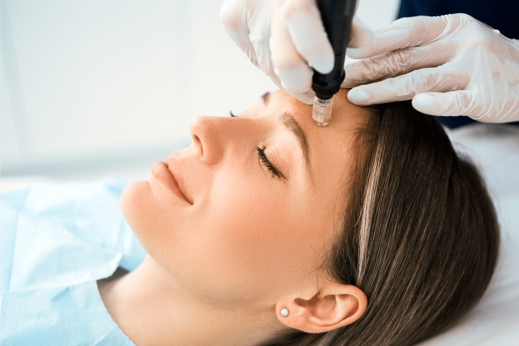 Microneedling at Mike Lee Laser & Skin Clinic