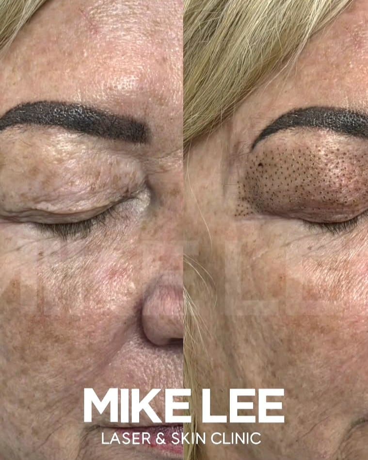 An eyelid before and after plasma skin tightening at Mike Lee Laser & Skin Clinic