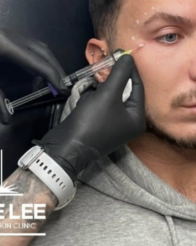 A polynucleotide injection beside the eye at Mike Lee Laser & Skin Clinic