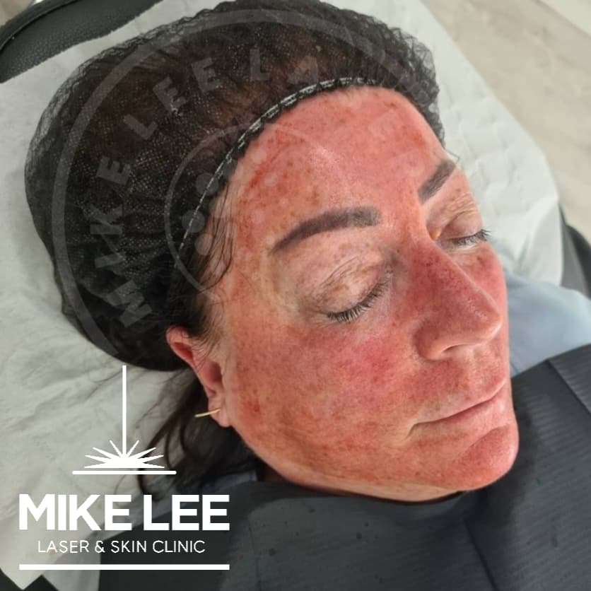 PRP (Vampire) Facial at Mike Lee Laser & Skin Clinic