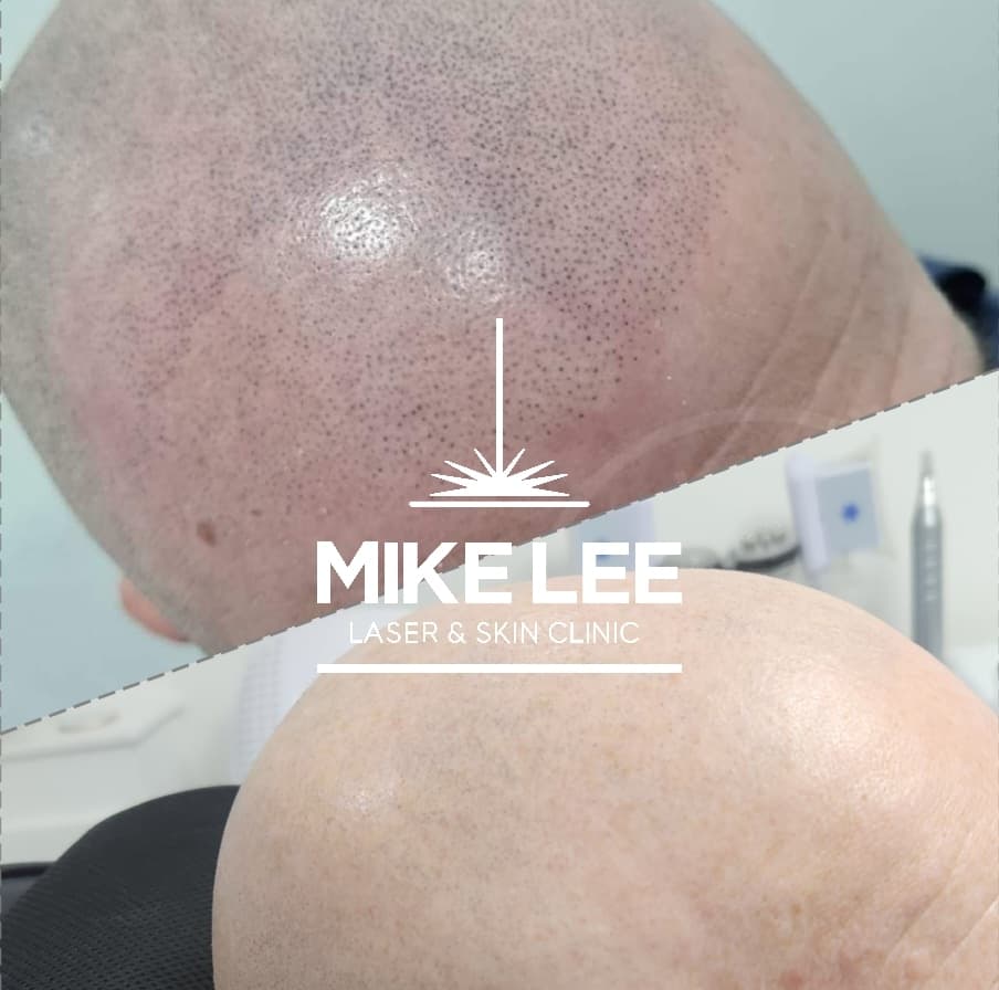 Scalp Micropigmentation Removal at Mike Lee Laser & Skin Clinic
