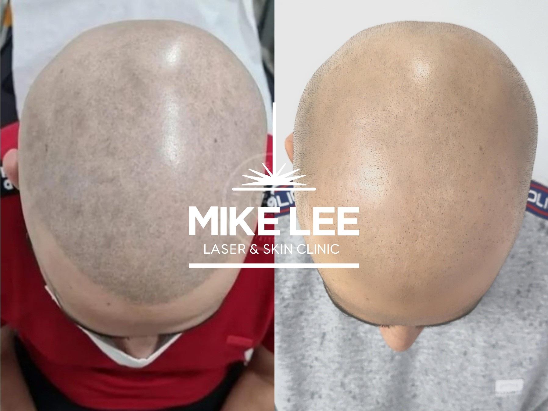 Scalp Micropigmentation Removal at Mike Lee Laser & Skin Clinic