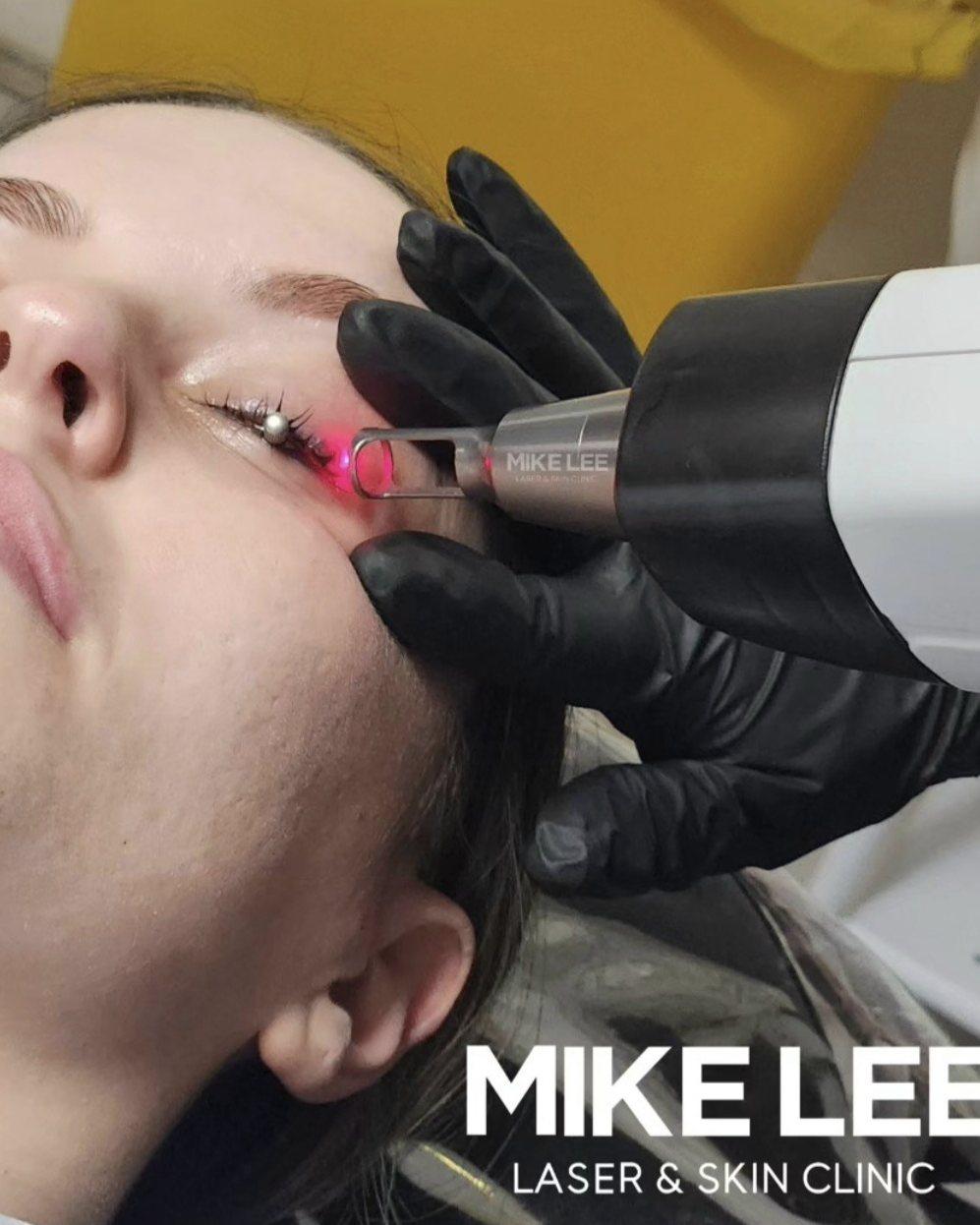 Laser tattoo eyeliner removal on a client's eyelid at Mike Lee Laser & Skin Clinic