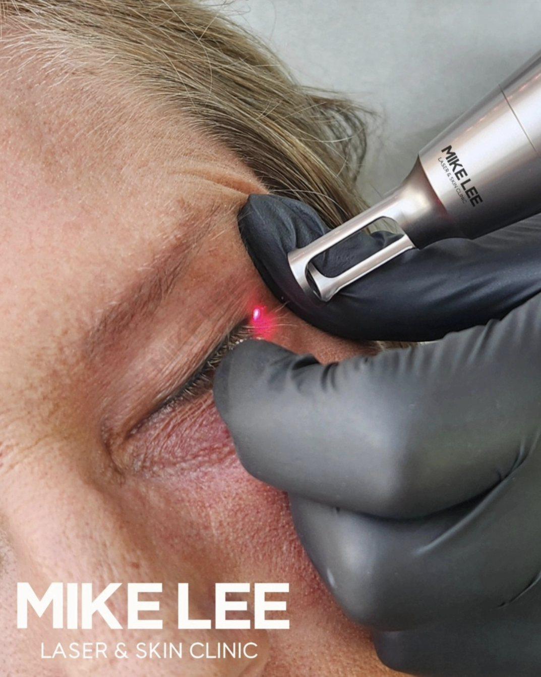 Laser removal of tattooed eyeliner at Mike Lee Laser & Skin Clinic