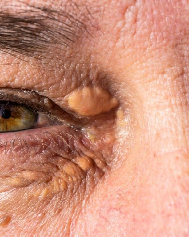 Xanthelasma deposits beside the eye at Mike Lee Laser & Skin Clinic