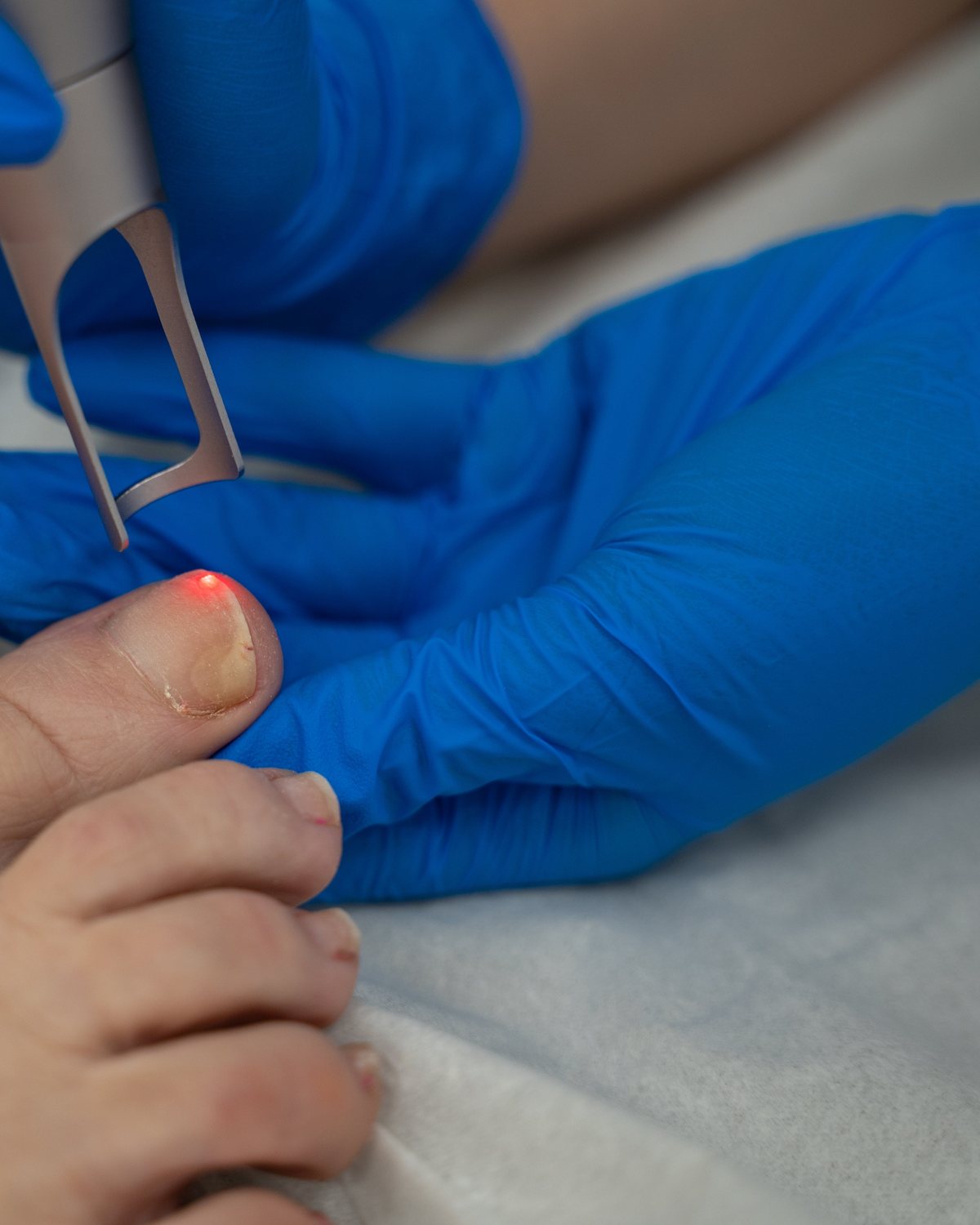 Laser fungal nail treatment on a toenail at Mike Lee Laser & Skin Clinic