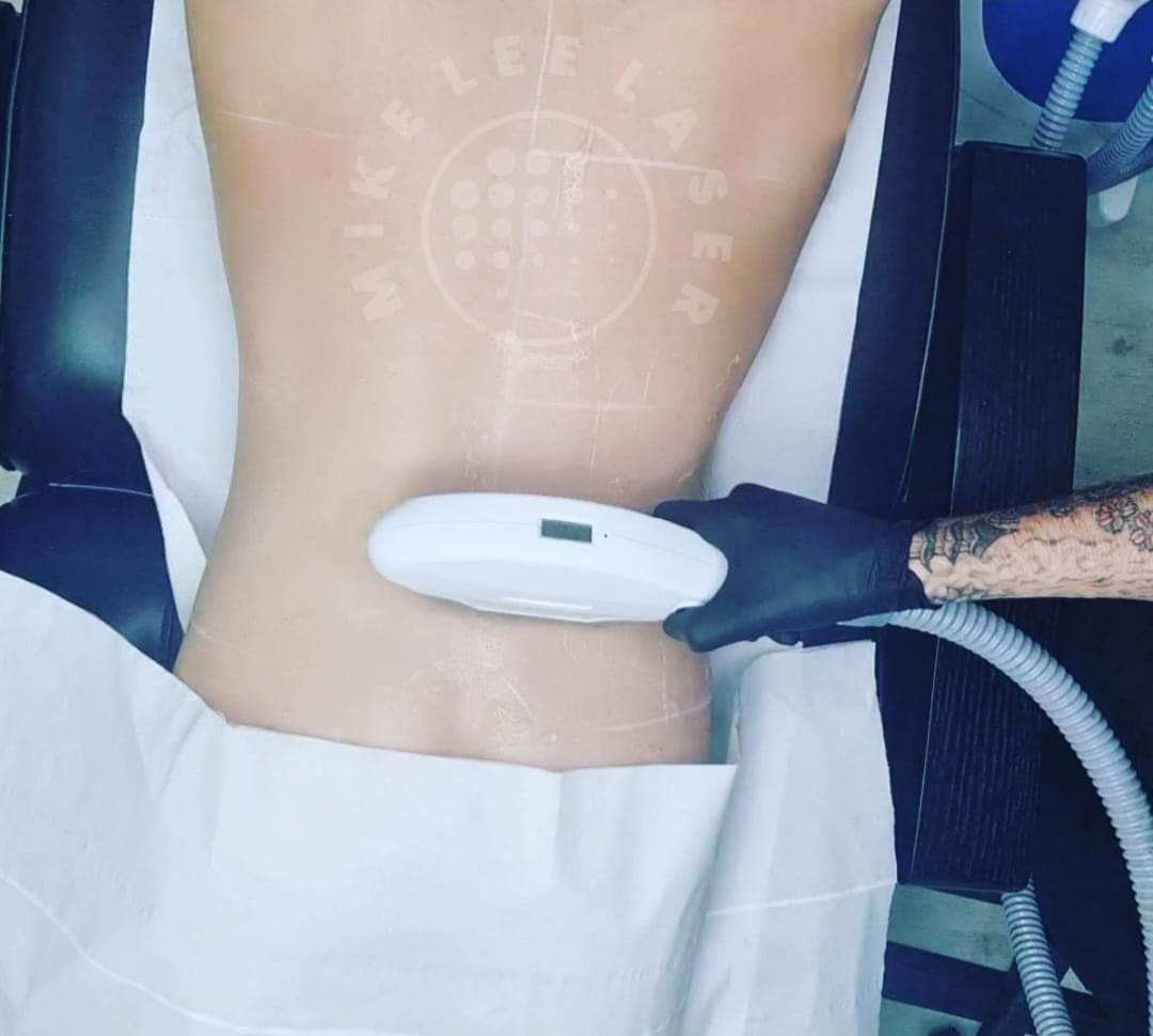Laser Hair Removal at Mike Lee Laser & Skin Clinic