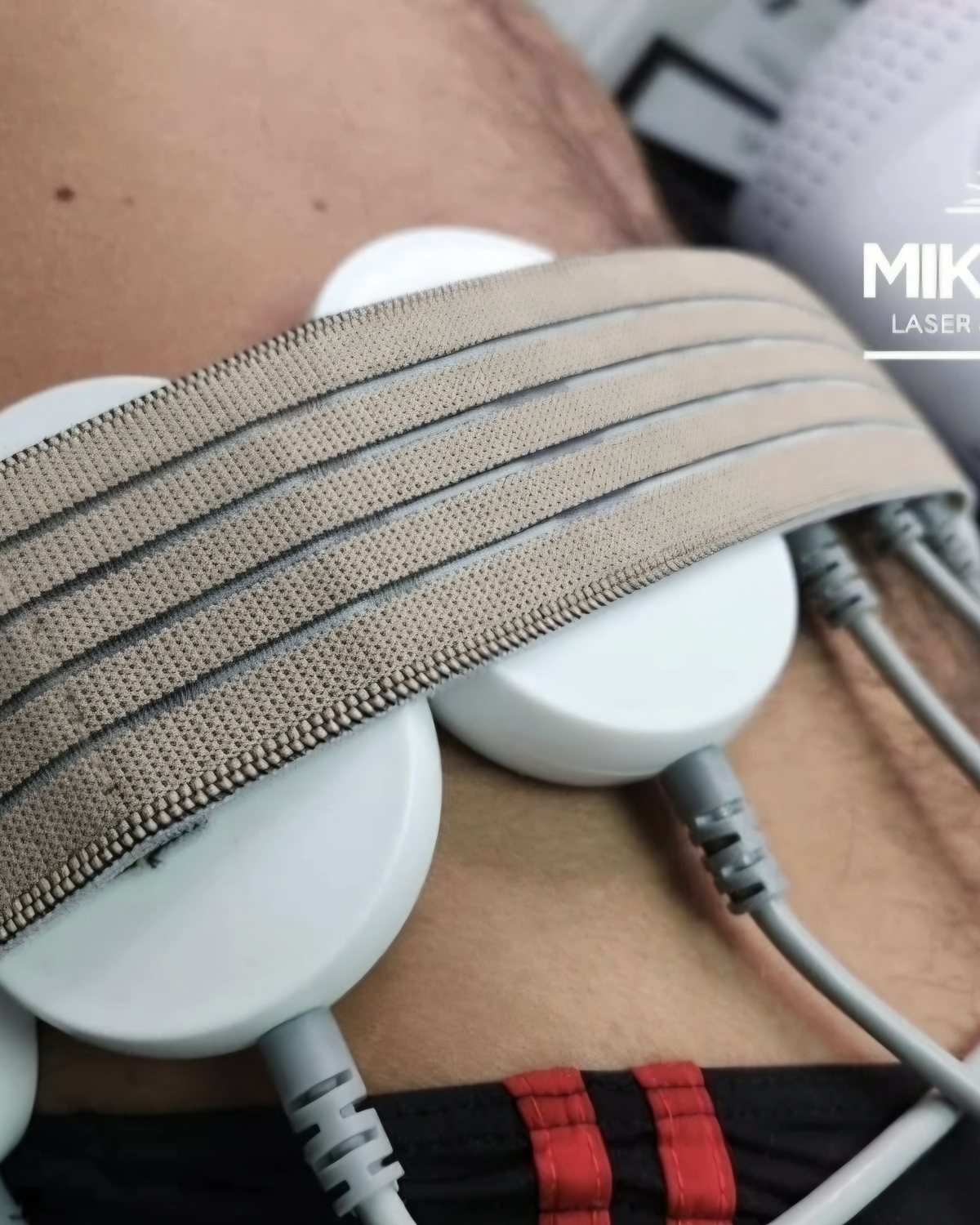 Laser lipolysis pads strapped to a client's abdomen at Mike Lee Laser & Skin Clinic