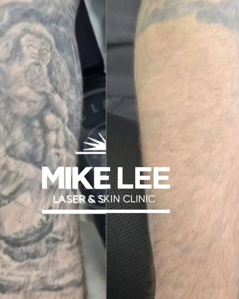 A tattooed arm before and after laser tattoo removal at Mike Lee Laser & Skin Clinic