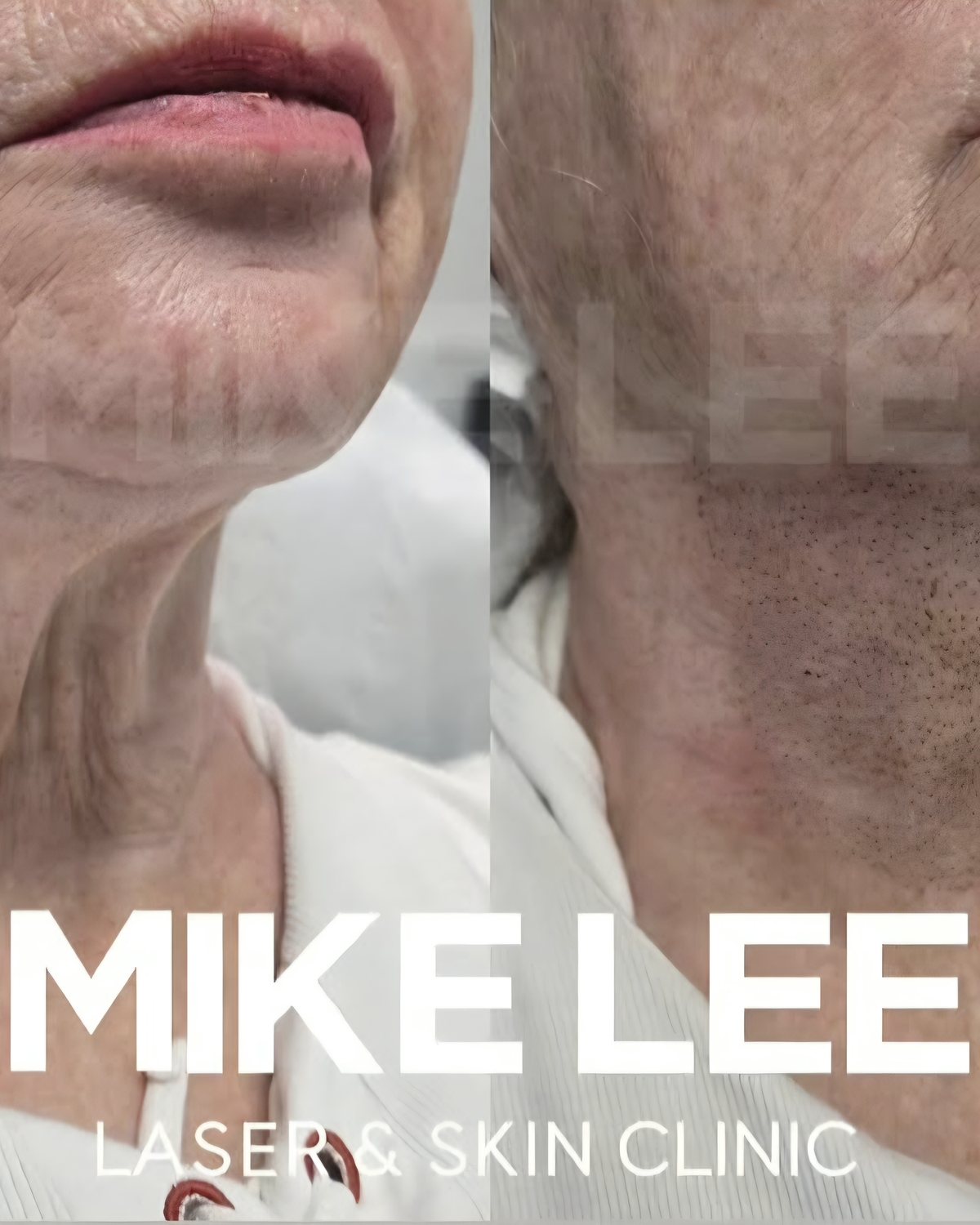 A client's neck before and after plasma skin tightening at Mike Lee Laser & Skin Clinic