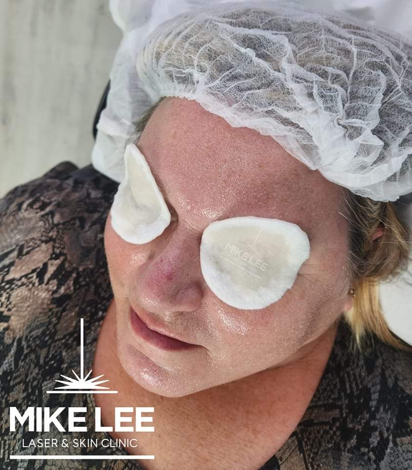 Skin Peels at Mike Lee Laser & Skin Clinic