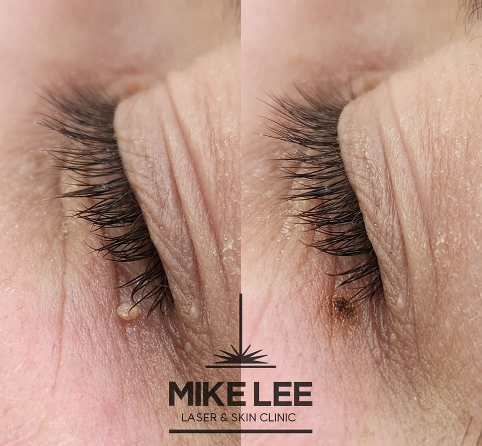 Skin Tag Removal at Mike Lee Laser & Skin Clinic